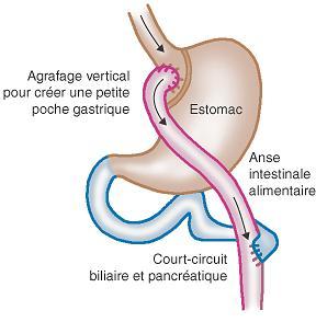 Bypass gastrique