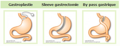 Chirurgie de l'obésité : anneau gastrique, sleeve et bypass gastrique Chirurgie bariatrique : gastrectomie, sleeve et by-pass
