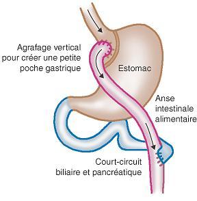 Bypass de l'estomac By-pass gastrique